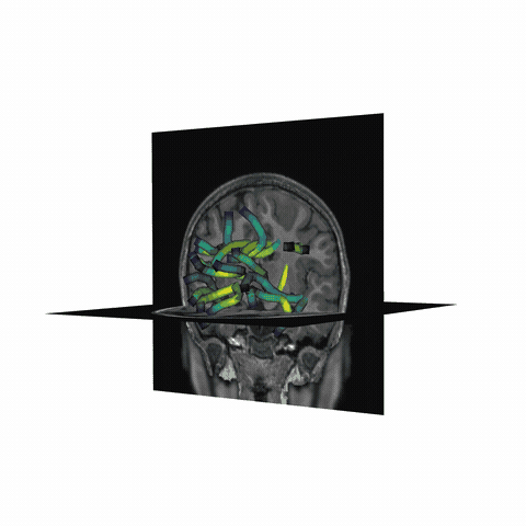 ../_images/sphx_glr_plot_stages_of_tractometry_012.gif