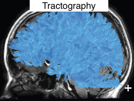 ../_images/tract_tractography.png